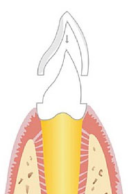 Zahnersatz und Implantate